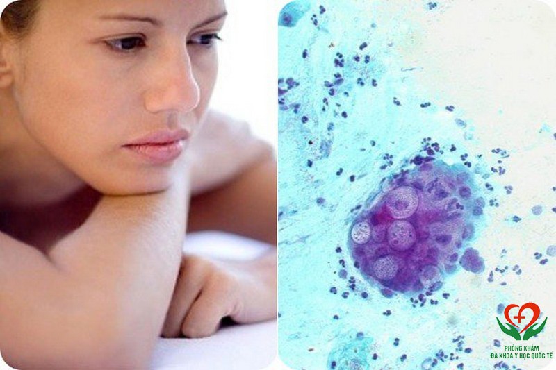 Nấm chlamydia gây bênh phụ khoa
