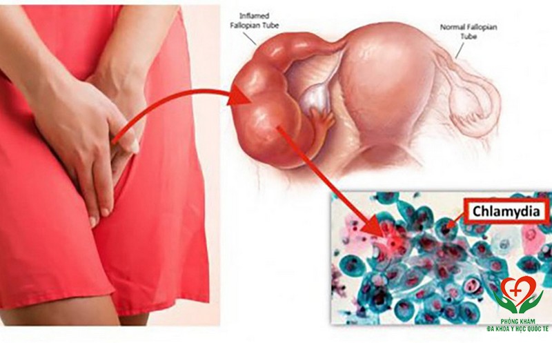 Nấm chlamydia có triệu chứng làm phụ nữa đau và ngứa vùng kín